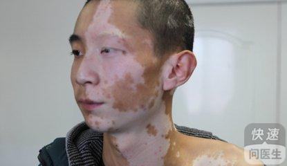 脸上白癜风怎样治疗  几种方法帮你解决
